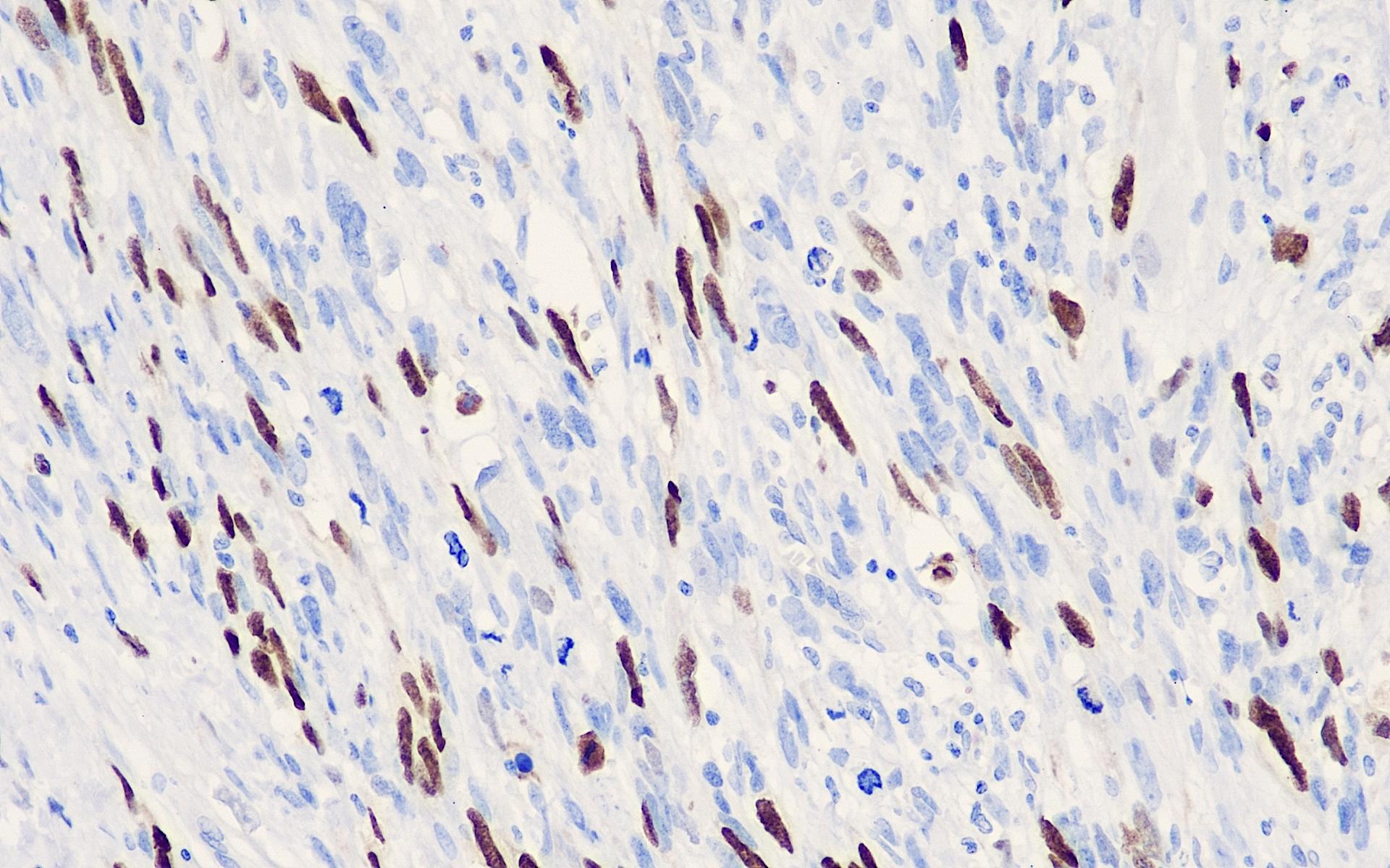 myogenin 20-2 横纹肌肉瘤